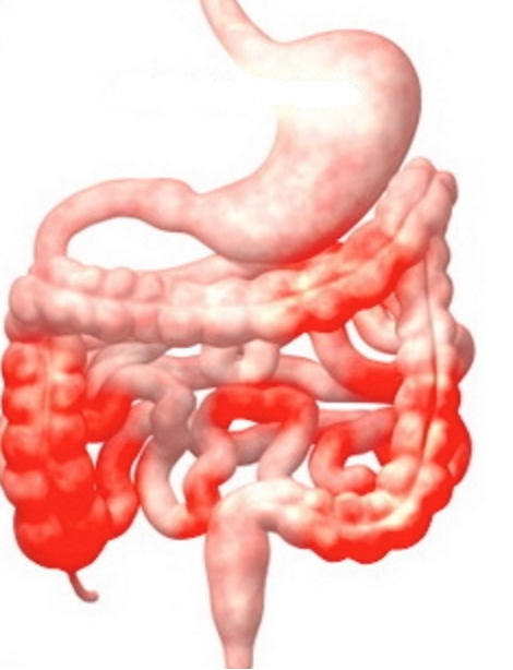 Bệnh Crohn là gì?