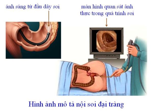 Quy trình nội soi đại tràng như thế nào