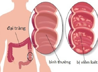 Bệnh viêm đại tràng