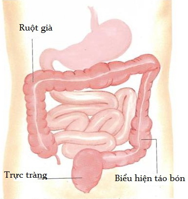 Nguyên nhân gây viêm trực tràng