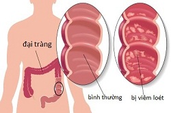 Bệnh viêm đại tràng là gì?