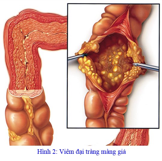 Bệnh viêm đại tràng màng giả