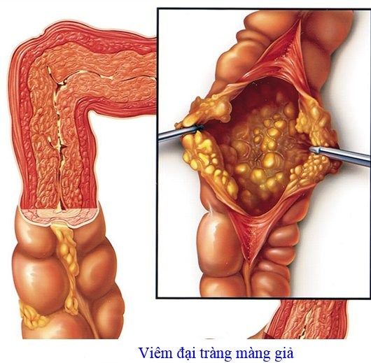 kien-thuc-can-biet-ve-benh-viem-dai-trang-gia-mac1