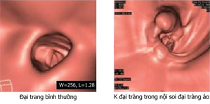 phuong-phap-noi-soi-dai-trang-ao-qua-ct-12-lat-cat1