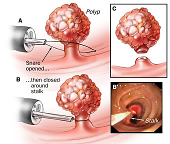 cach-chua-polyp-dai-trang