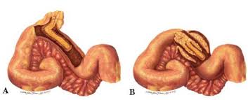 benh-viem-tui-thua-meckel-o-tre-em