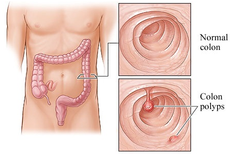 Polyp đại tràng là gì?