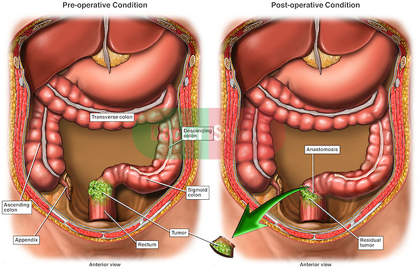 Surgery for Colon and Rectal Cancer.