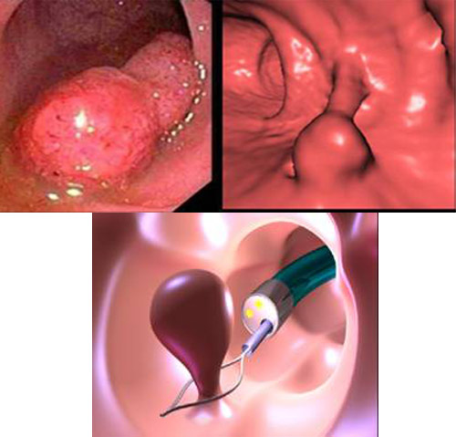 cat-polyp-dai-trang-co-dau-khong