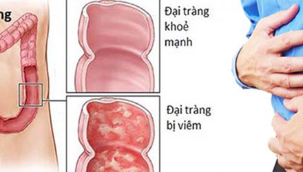 dai-trang-hoan-ACP1