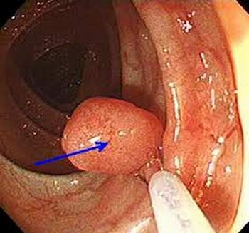 nguy-co-ung-thu-dai-truc-trang-vi-polyp