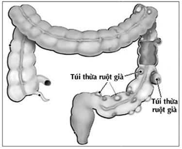 Chẩn đoán và điều trị viêm túi thừa Meckel