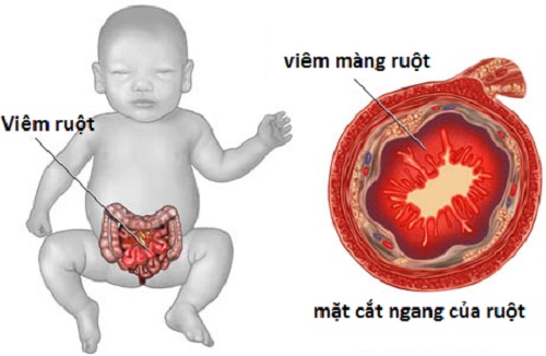 Viêm ruột hoại tử: Nguyên nhân, chẩn đoán và cách xử lý