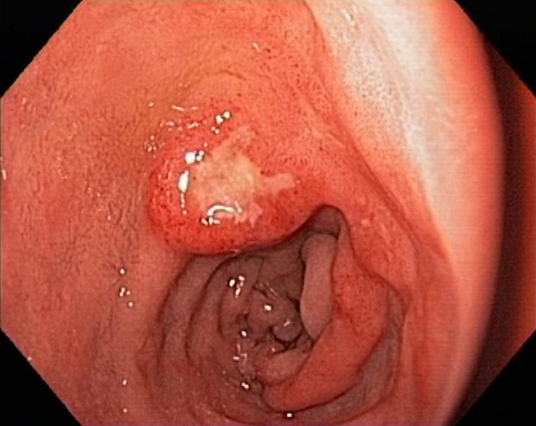 ăn xong bị đau bụng đi ngoài do viêm loét dạ dày