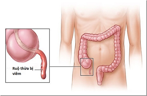 Ăn xong bị đau bụng đi ngoài do viêm ruột thừa