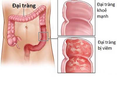 Khắc phục chứng tiêu chảy kéo dài do bệnh đại tràng