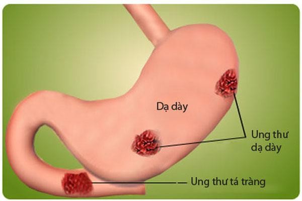 Tiêu chảy kéo dài do ung thư