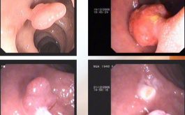 Hình ảnh quá trình cắt polyp đại tràng qua nội soi