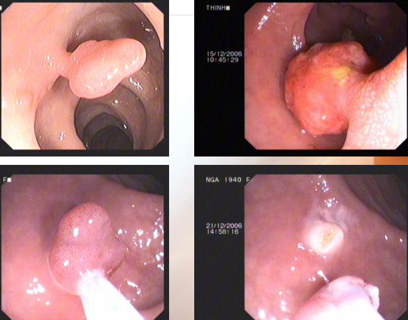 Hình ảnh quá trình cắt polyp đại tràng qua nội soi