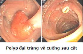 Gốc polyp đại tràng trước và sau khi cắt bằng nội soi