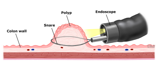 Quy trình thực hiện cắt polyp đại tràng qua nội soi