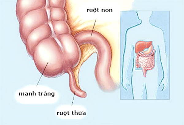 viêm hồi manh tràng là gì