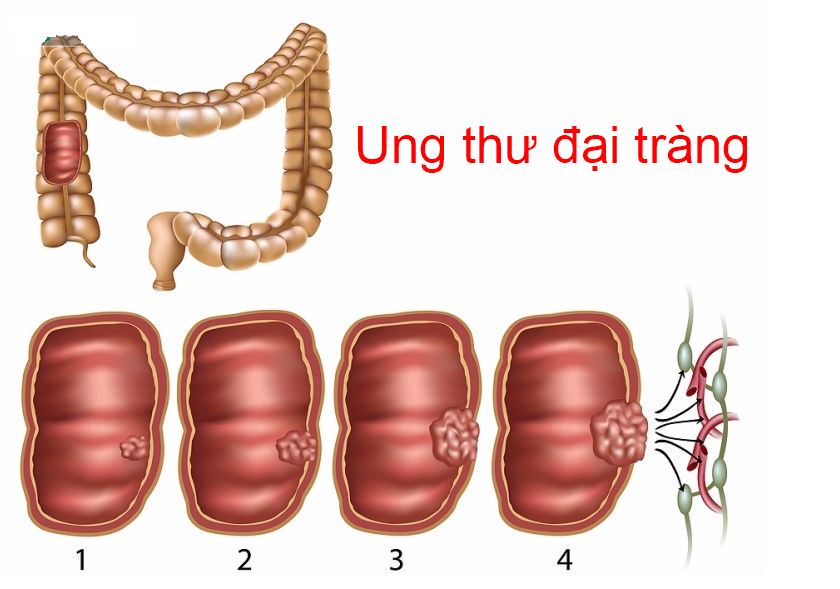 Biến chứng ung thư của bệnh viêm manh tràng