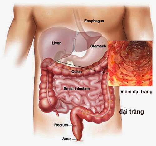 Bệnh viêm đại tràng gây đi ngoài phân nát