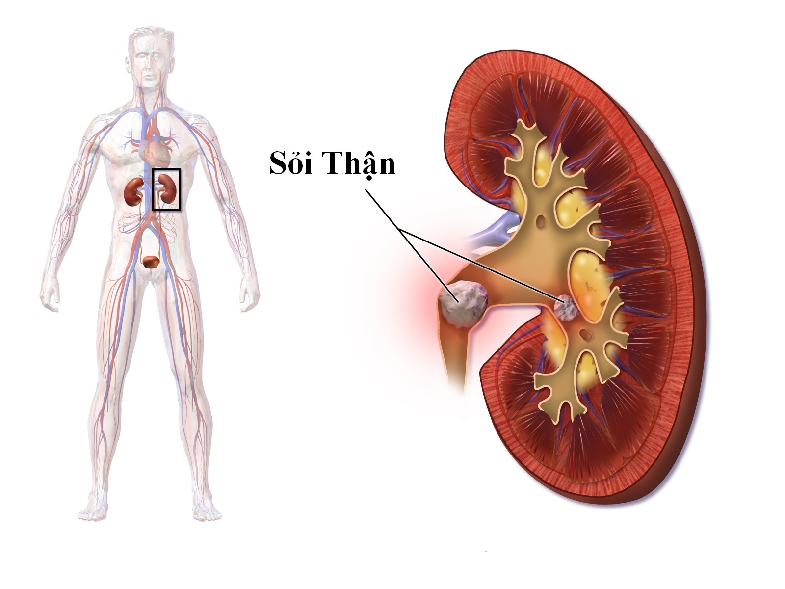 Đau âm ỉ bên bụng phải là bệnh sỏi thận