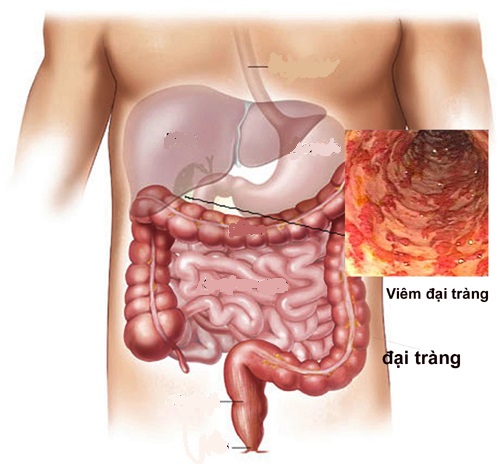 Ngày đi vệ sinh 3-4 lần có phải bị hội chứng ruột kích thích không (2)