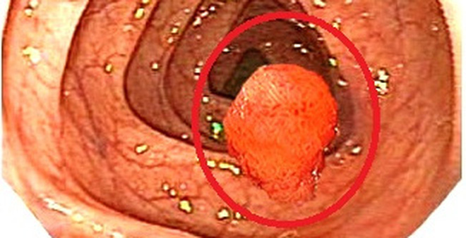 Polyp trực tràng là bệnh lý hậu môn trực tràng nhiều người mắc phải