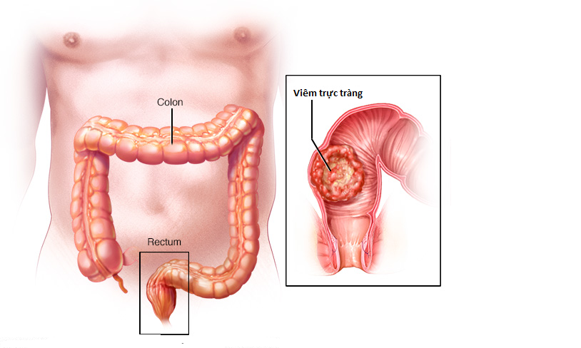 Viêm trực tràng là một trong các bệnh về hậu môn trực tràng thường gặp