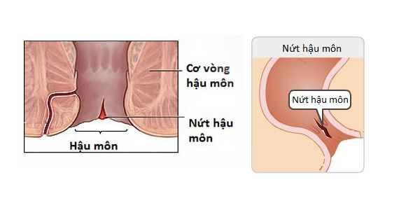 Nứt kẽ hậu môn gây đi ngoài ra máu và chất nhày