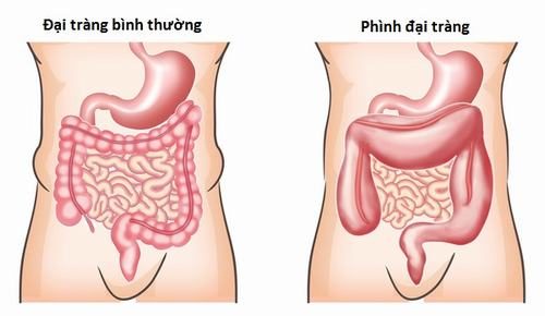 Phình đại tràng ở người lớn