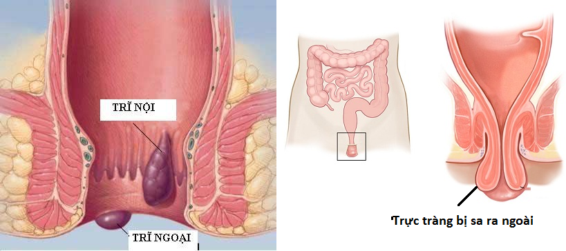 Phân biệt bệnh sa trực tràng và trĩ