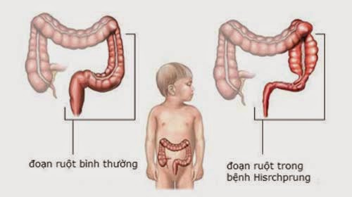 phẫu thuật phình đại tràng bẩm sinh