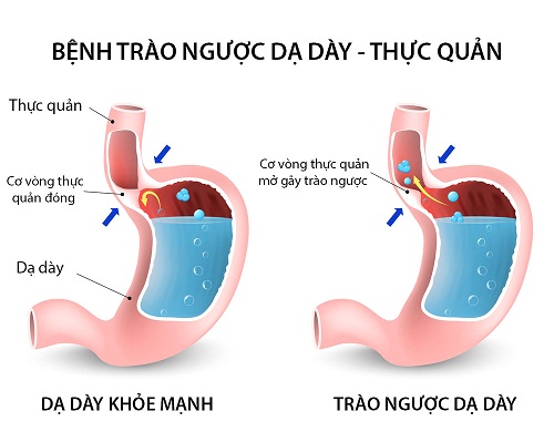 Trào ngược dạ dày thực quản là nguyên nhân gây đau bụng